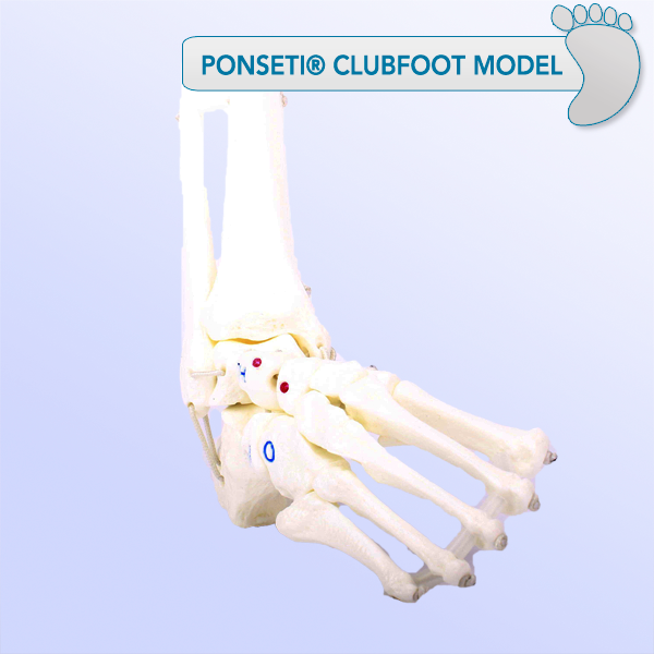 Ponseti Clubfoot Model